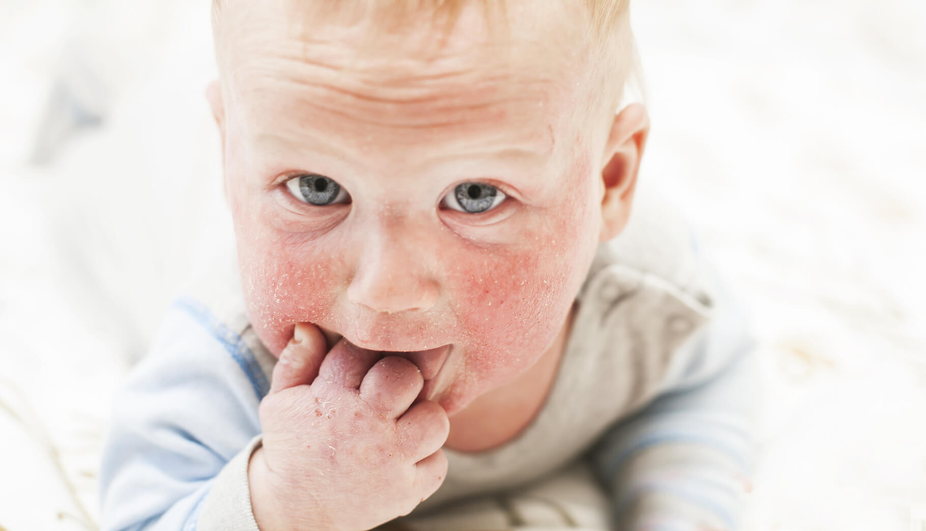 Alergia pokarmowa u dzieci i niemowląt