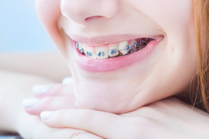 Teeth with braces.